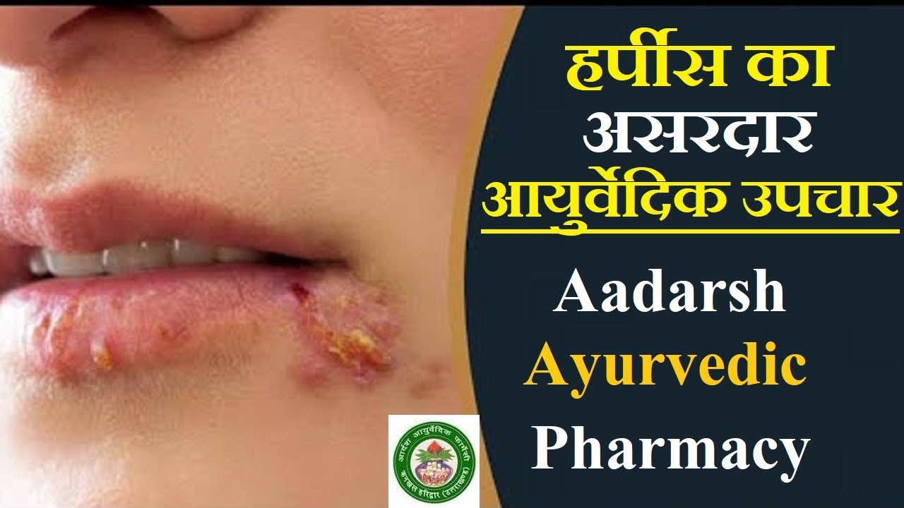 Herpes को Ayurvedic उपचार से करें दूर Adarsh Ayurvedic Ep42 part