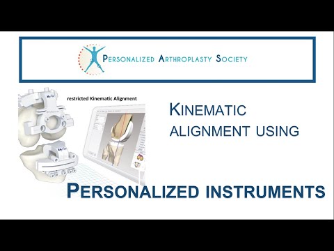Restricted Kinematic Alignment TKA - with Personalized Instruments