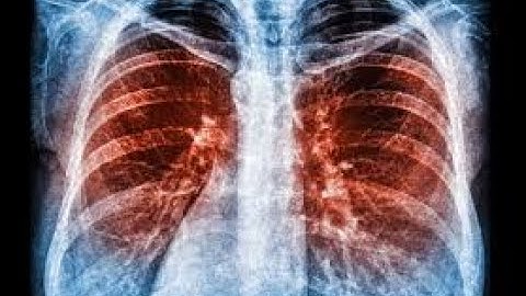 CPT code for Pulmonary imaging - simplify medical coding