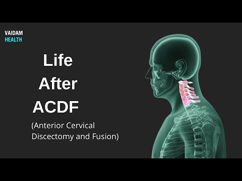 Life After ACDF (Anterior Cervical Discectomy and Fusion)