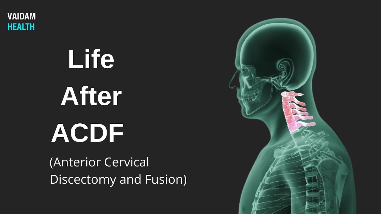 Life After Acdf Anterior Cervical Discectomy And Fusion Youtube