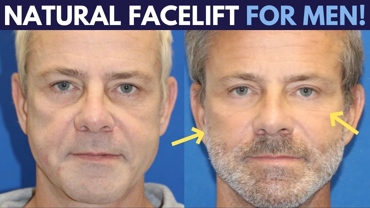 How The Male Facelift Differs From Facelifts For Women | Look As Natural As Possible!