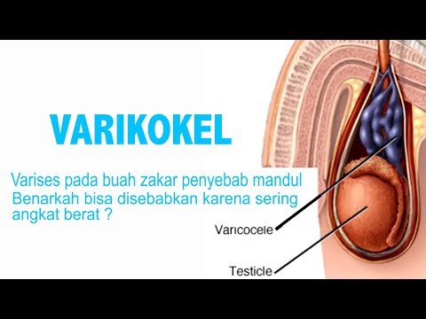 Video: Varicocelectomy: Prosedur, Efek Samping, Kesuburan, Dan Banyak Lagi