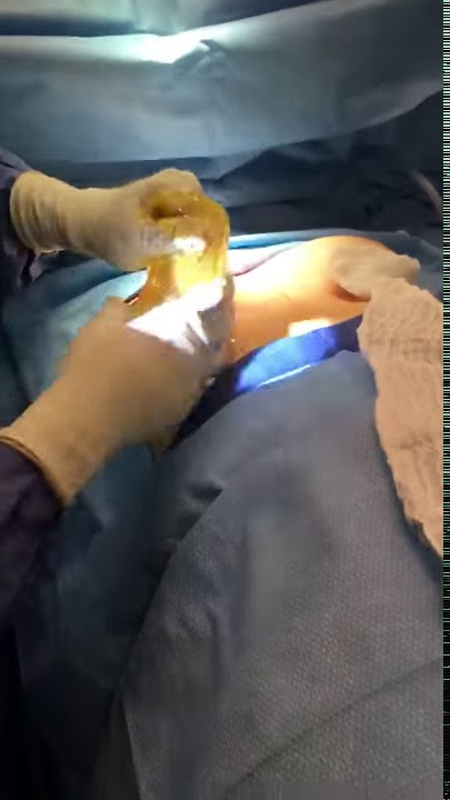 Dr. Linder Removes 32 Year Old Ruptured Breast Implant