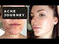 My Hormonal Acne Journey... what ACTUALLY stopped my acne (not roaccutane)