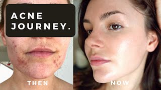 My Hormonal Acne Journey... what ACTUALLY stopped my acne (not roaccutane)