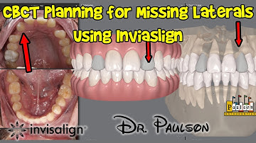 CBCT with invisalign and missing laterals