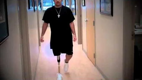Caleb - Above Knee Amputee; First day walking with...