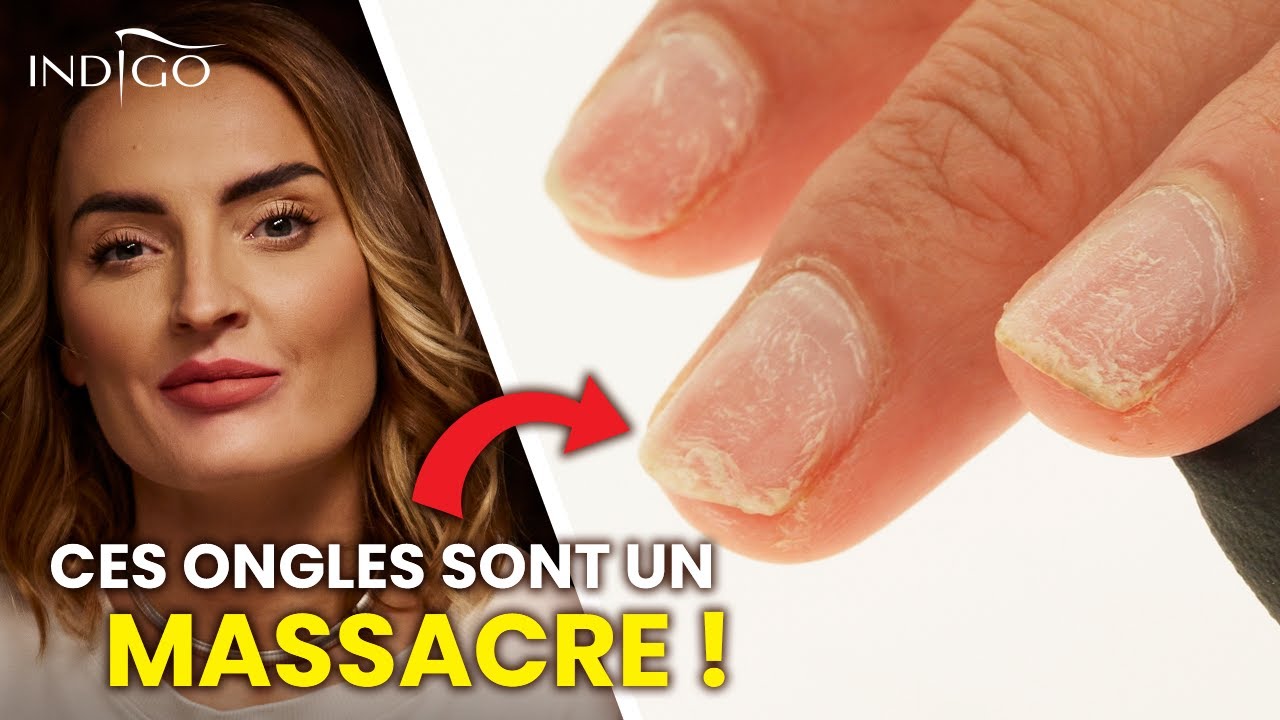 Ces ongles sont un désordre ! - réparation d'un ongle abîmé étape par étape | Indigo Nails