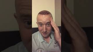 Jal day 5Hair Transplant Day Five