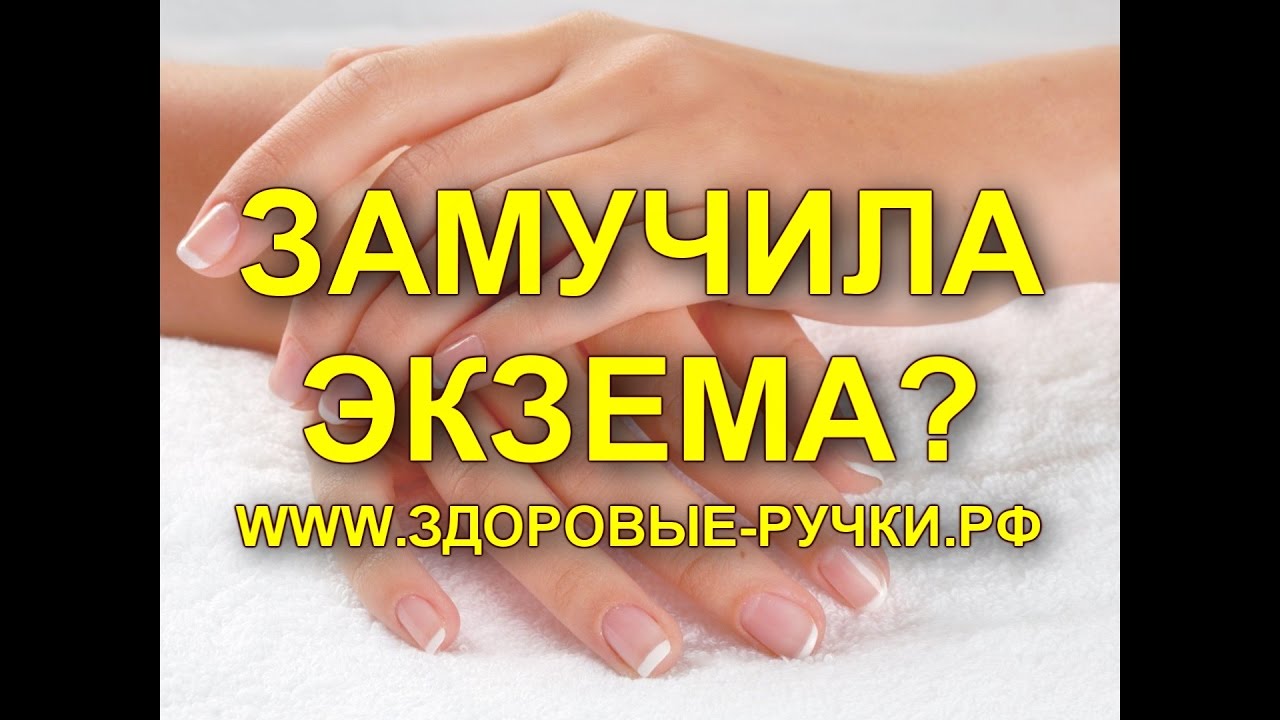 Экзема На Руках? Лечение Экземы! Избавим От Экземы! - YouTube