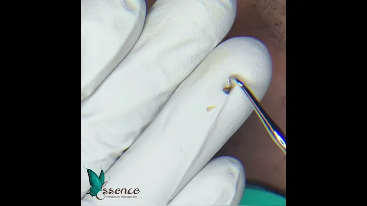 Blackhead extraction