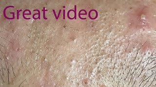 Acne Treatment Huong Da Nang# membership 016   Treatment for Dung | great video