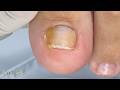👀Veja como cortar uma unha enterrada #satisfying #nails
