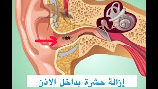 كيفية إخراج حشرة من داخل الأذن بكل سهولة