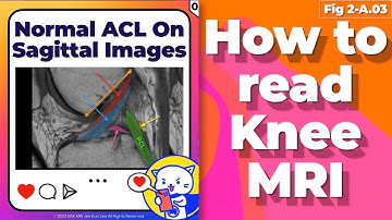 (Fig 2-A.03) Normal ACL on Sagittal images
