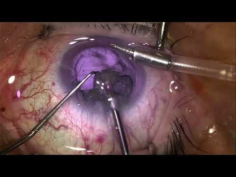 Beyeonics One Invisible Light in Action Beyeonics One Invisible Light in Action