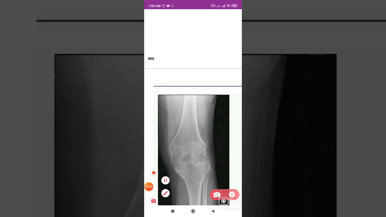 Hemophilic arthropathy