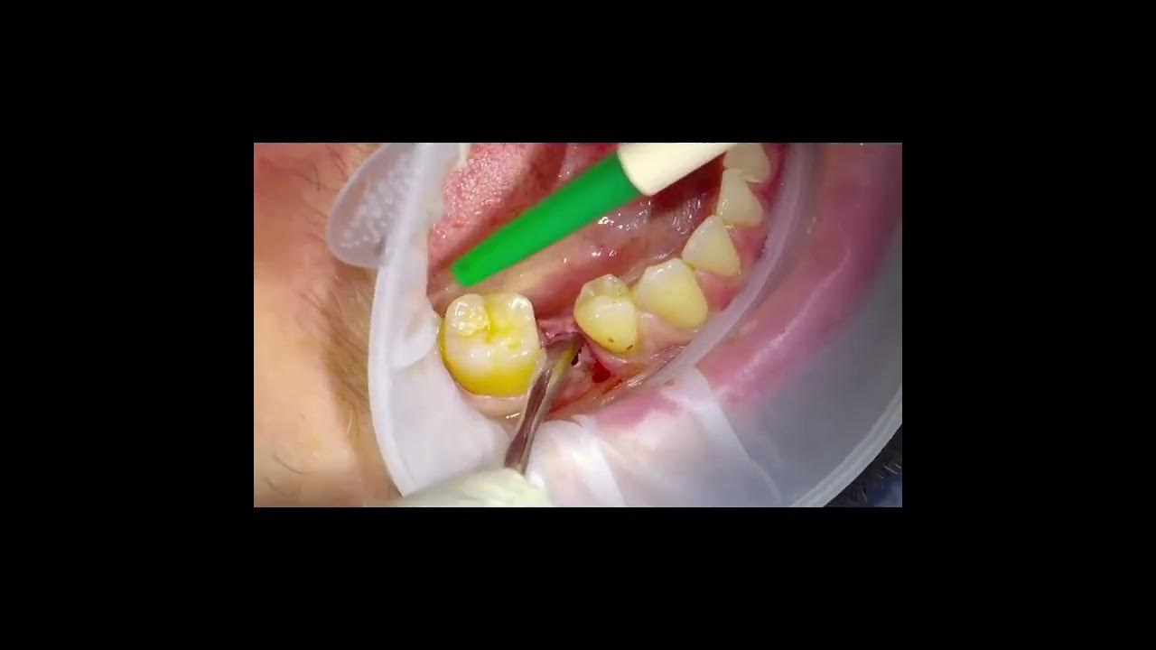 dental implants procedure YouTube