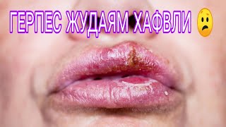 Герпес. Герпес шунчаликхам хафлими ? Герпес. Герпес шунчаликхам хафлими ?