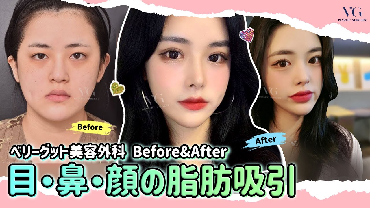 韓国整形 目 鼻整形 顔の脂肪吸引 劇的ビフォーアフター ベリーグット美容外科pat2 Youtube