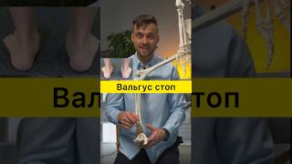 Вальгус стоп