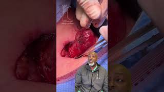 Multinodular Goiter: Thyroid Mass or Thyroid Cancer