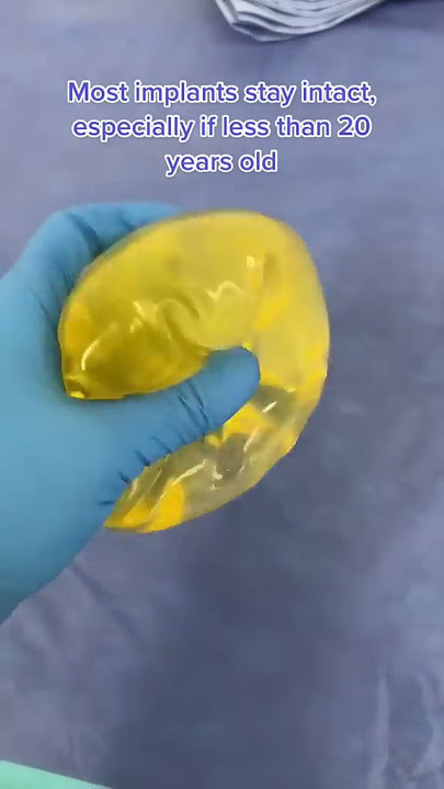 Why Are These 18 Year Old Breast Implants Slightly Yellow? #shorts #breastimplants