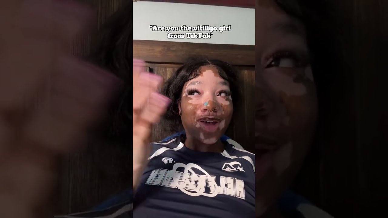 Issa JOKEEEEE Vitiligo Explore Explorepage Shortsfeed