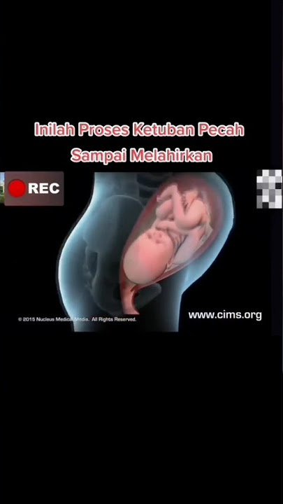 Proses Ketuban Pecah sampai Melahirkan