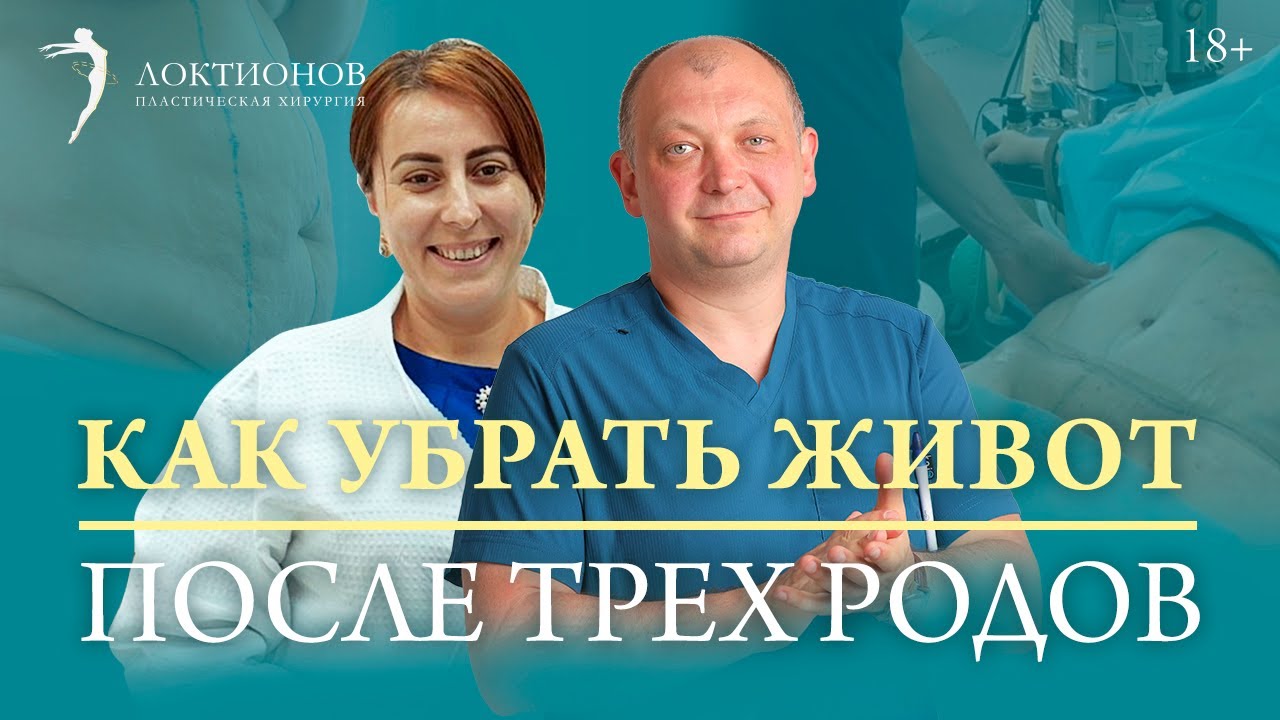 Восстановление фигуры после ТРЕХ родов // 18+