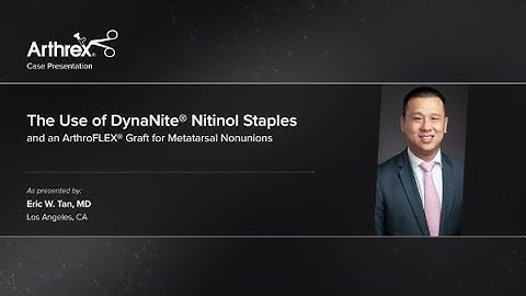 The Use of DynaNite® Nitinol Staples and an ArthroFLEX® Graft for Metatarsal Nonunions