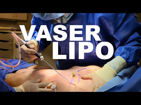 Vidéo: Liposuccion VASER: Procédure, Coût Et à Quoi S'attendre