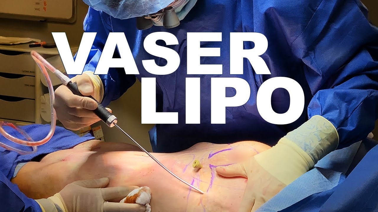 Liposuction Surgery Meaning