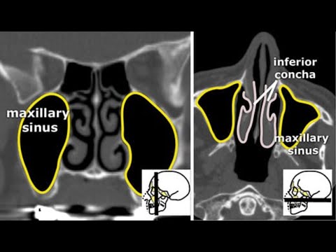 Компьютерная томография околоносовых пазух: почему важно знать анатомию, как не пропустить патологию