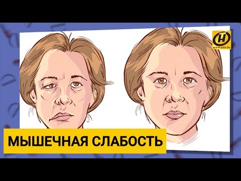 Миастения или слабость мышц - что это и как лечить?