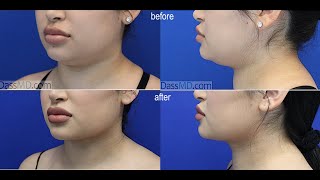 Neck Lift - Tummy Tuck Best Results In Beverly Hills Shown By Dr. Dass