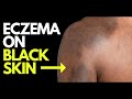 Doctor explains what ECZEMA looks like on BLACK SKIN - plus photos, diagnosis and treatment