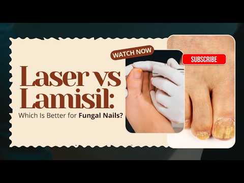 Laser vs Lamisil: Which Is Better for Fungal Nails thumbnail