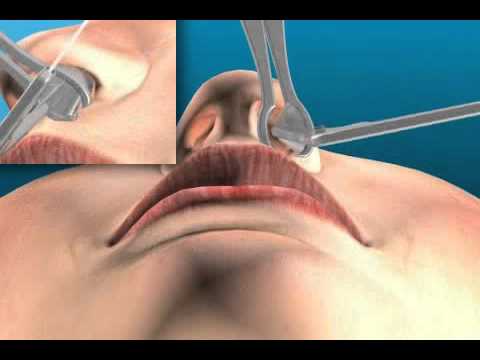 Das Nasenspekulum ist ein spezielles Instrument zum spreizen der Nase und w...