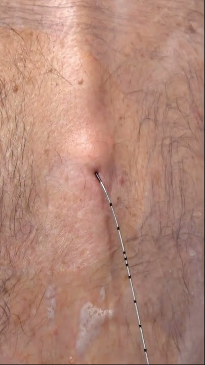 Removing the Epidural Needle #meded #surgicaleducation #or #surgery #stepbystep #learn #epidural