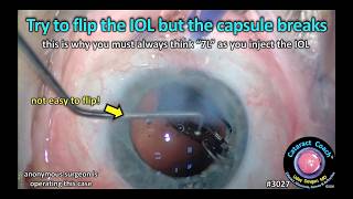 CataractCoach™ 3027: try to flip the IOL but the capsule breaks