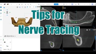 Implant Planning Basics  (Atomica AI) - Step 5. Nerve Tracing