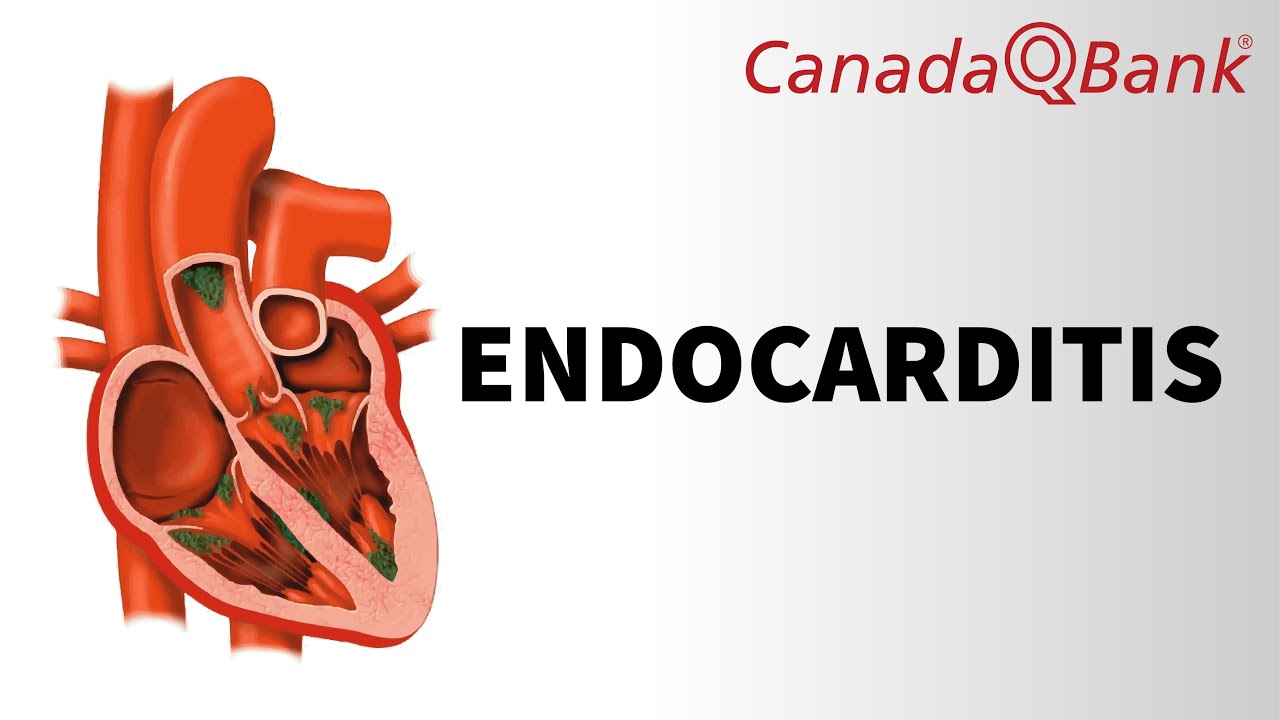 Endocarditis YouTube