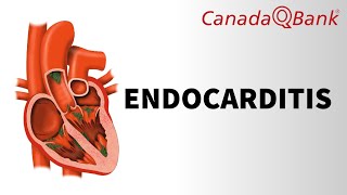 Endocarditis