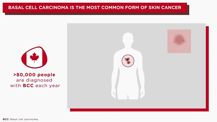 What happens if squamous cell carcinoma is left untreated