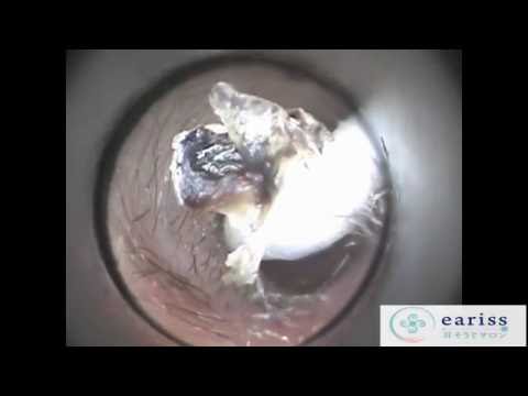 Vol.30【耳掃除】動画UP希望～素直な耳垢…eariss