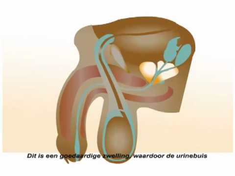 Video: Prostaathyperplasie - Symptomen, Behandeling