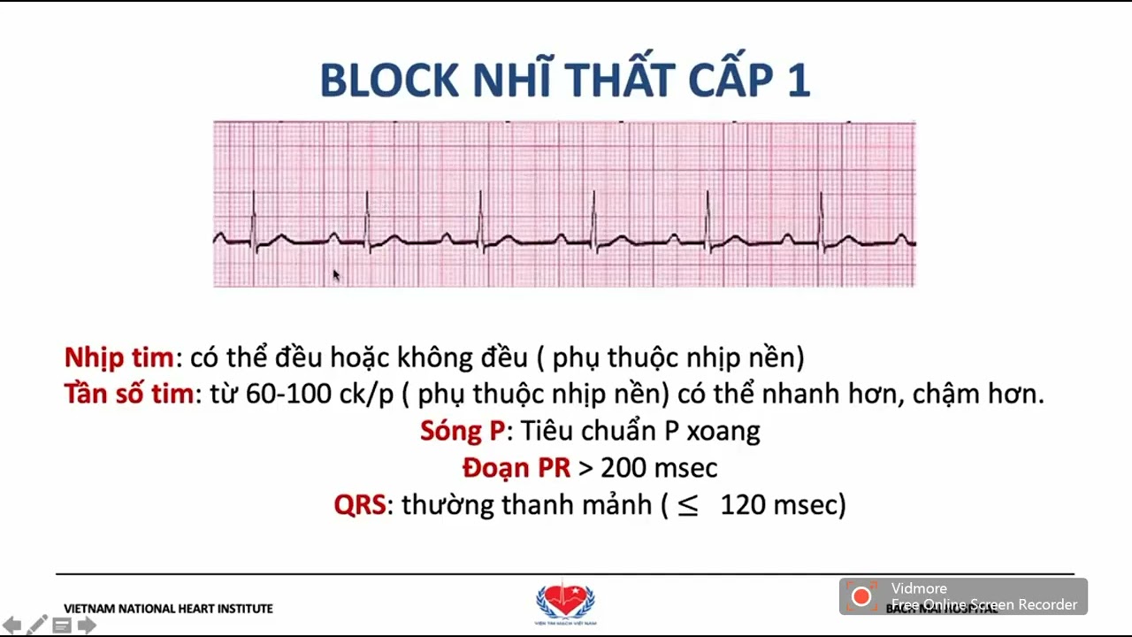 ECG CHẨN ĐOÁN BLOCK NHĨ THẤT