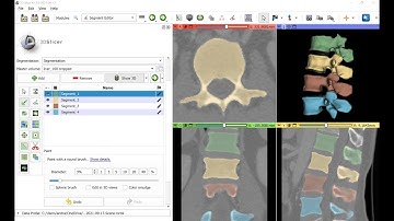 Semi-automatic vertebra segmentation on CT